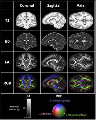 Superior Longitudinal Fasciculus: A Review of the Anatomical Descriptions With Functional Correlates